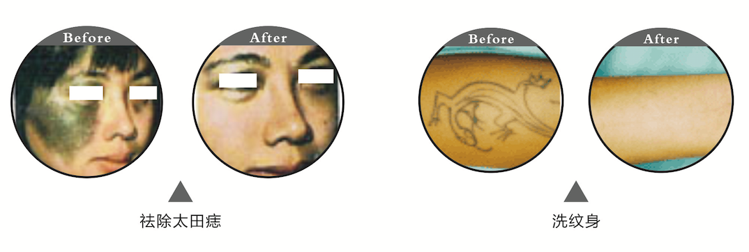 脉冲nd:yag对比图